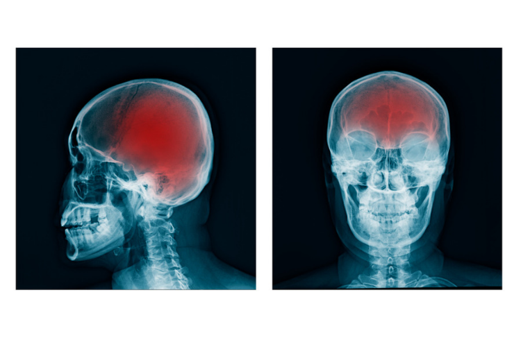 cannabis for brain trauma scans